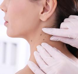 Czerniaki: jak rozpoznać raka skóry?