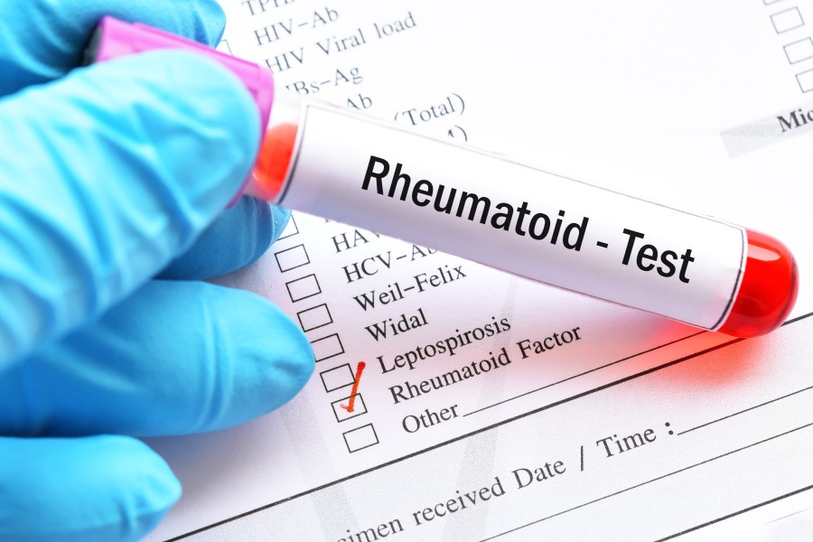 Próbka krwi przeznaczona do badania czynnika reumatoidalnego (RF).