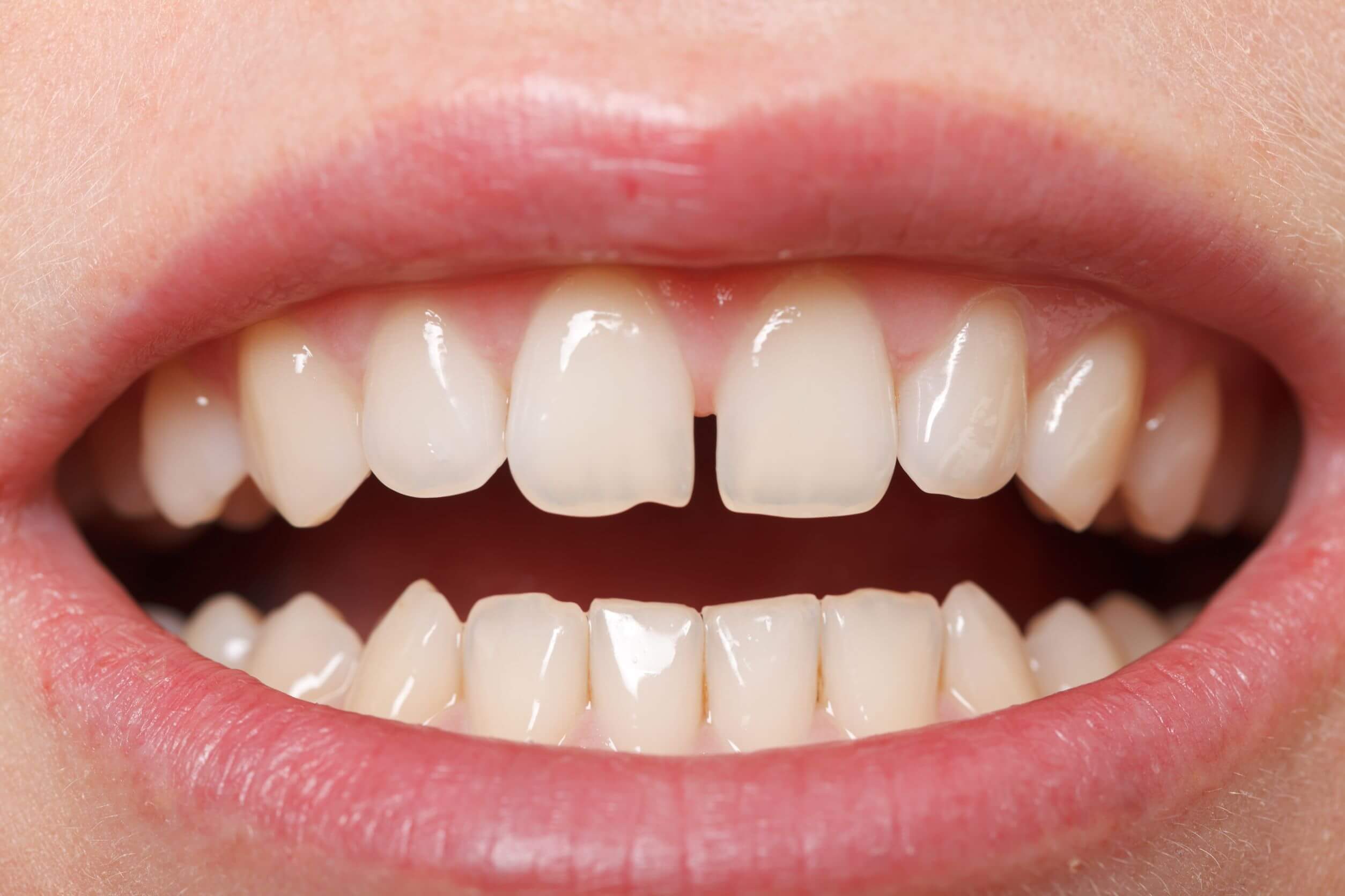 diastema między zębami