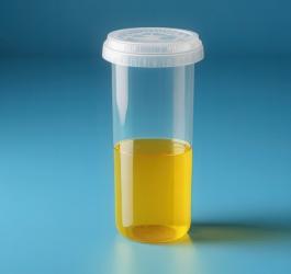 Pojemnik z moczem przeznaczonym do badania dobowej zbiórki moczu (DZM).