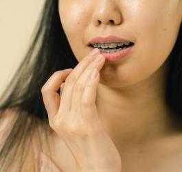 Kobieta ma na zębach niedawno założony aparat ortodontyczny.