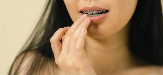 Kobieta ma na zębach niedawno założony aparat ortodontyczny.