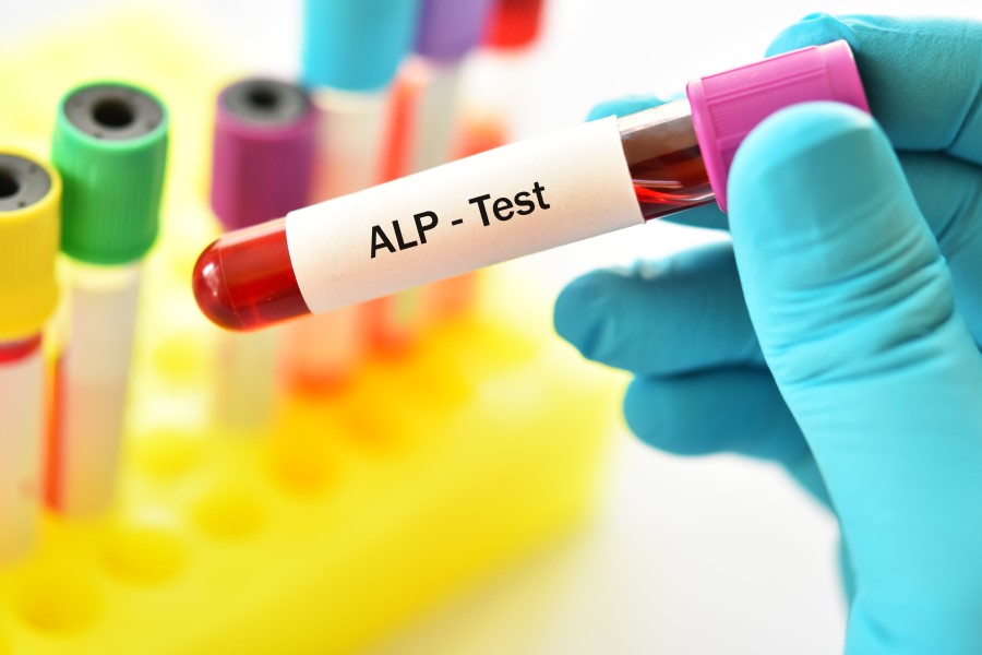 Diagnosta trzyma w ręce próbkę krwi do badania fosfatazy alkaicznej (ALP).