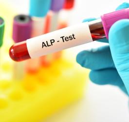 Diagnosta trzyma w ręce próbkę krwi do badania fosfatazy alkaicznej (ALP).