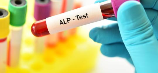 Diagnosta trzyma w ręce próbkę krwi do badania fosfatazy alkaicznej (ALP).