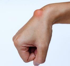 Ganglion − co to jest?