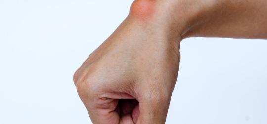 Ganglion − co to jest?