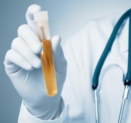 Lekarz trzyma w ręce fiolkę z próbką moczu do badania stężenia glukozy w moczu.