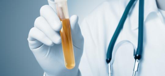 Lekarz trzyma w ręce fiolkę z próbką moczu do badania stężenia glukozy w moczu.