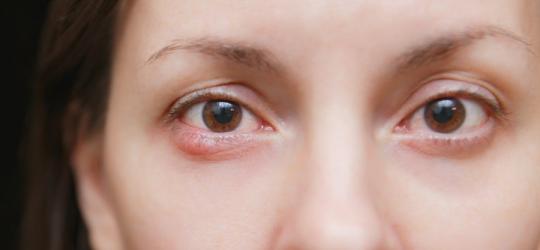 Zbliżenie na twarz kobiety. Na dolnej powiece ma bolesną gradówkę.