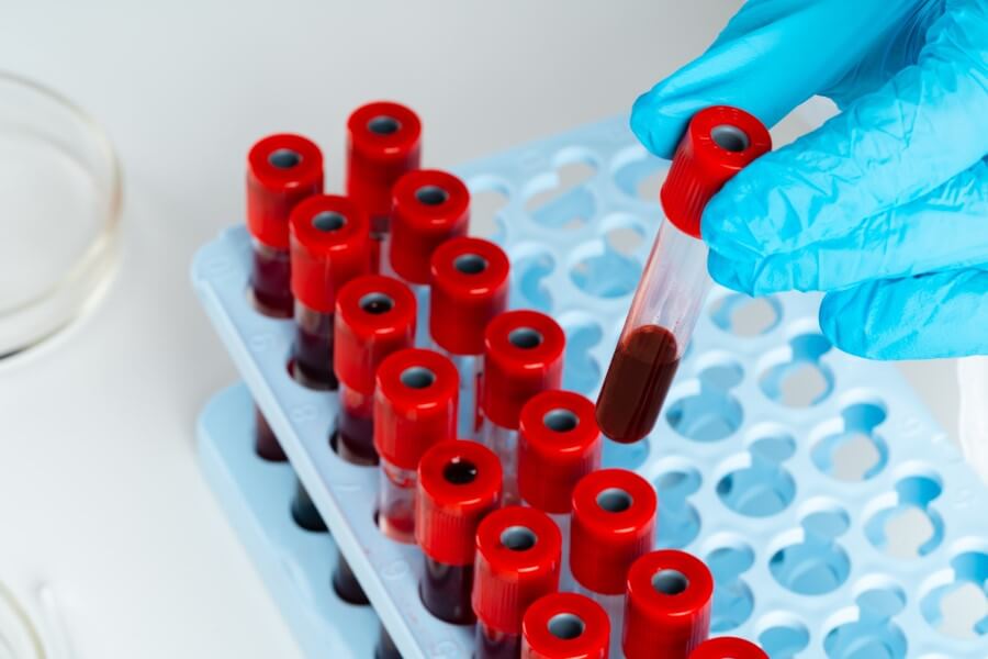 Diagnosta sięga po próbkę krwi, aby zbadać m.in. poziom granulocytów.