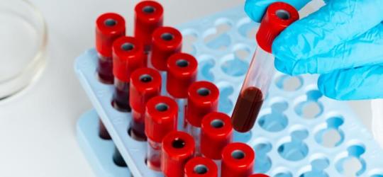 Diagnosta sięga po próbkę krwi, aby zbadać m.in. poziom granulocytów.