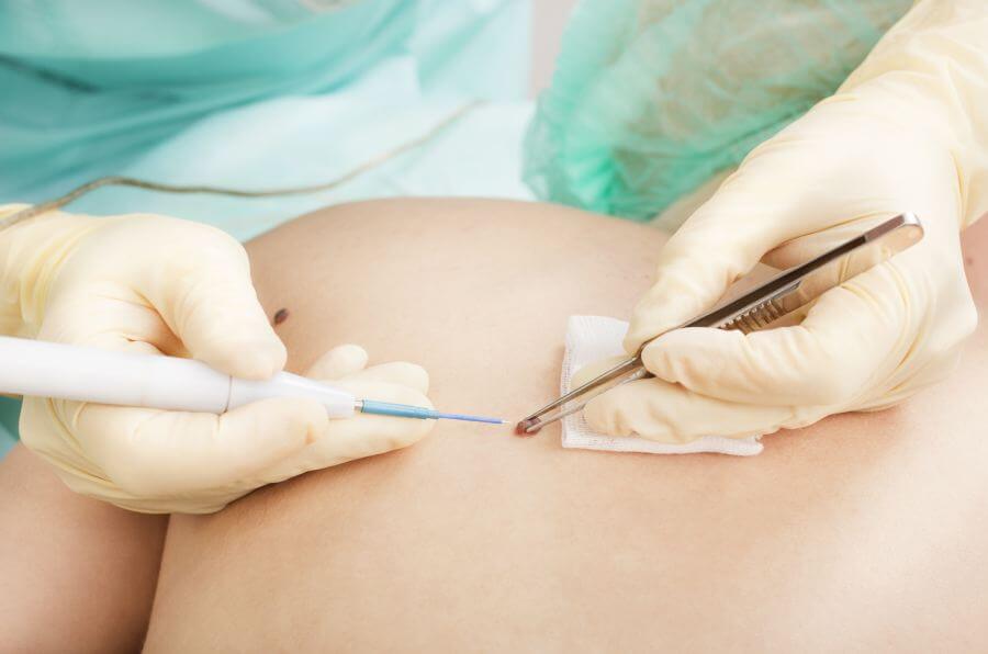 główne usuwanie pieprzyków