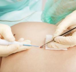 główne usuwanie pieprzyków