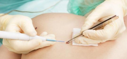 główne usuwanie pieprzyków