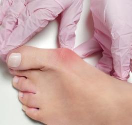 Lekarz bada stopę pacjentki z widocznym haluksem.