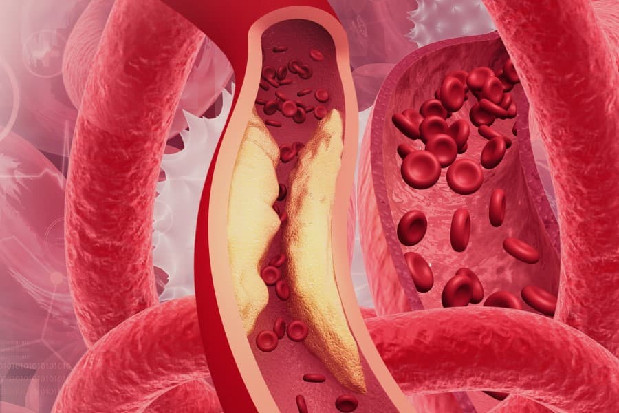 Model układu krwionośnego z widocznymi objawami hipercholesterolemii.