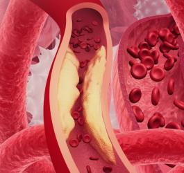 Model układu krwionośnego z widocznymi objawami hipercholesterolemii.