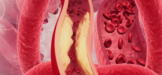 Model układu krwionośnego z widocznymi objawami hipercholesterolemii.