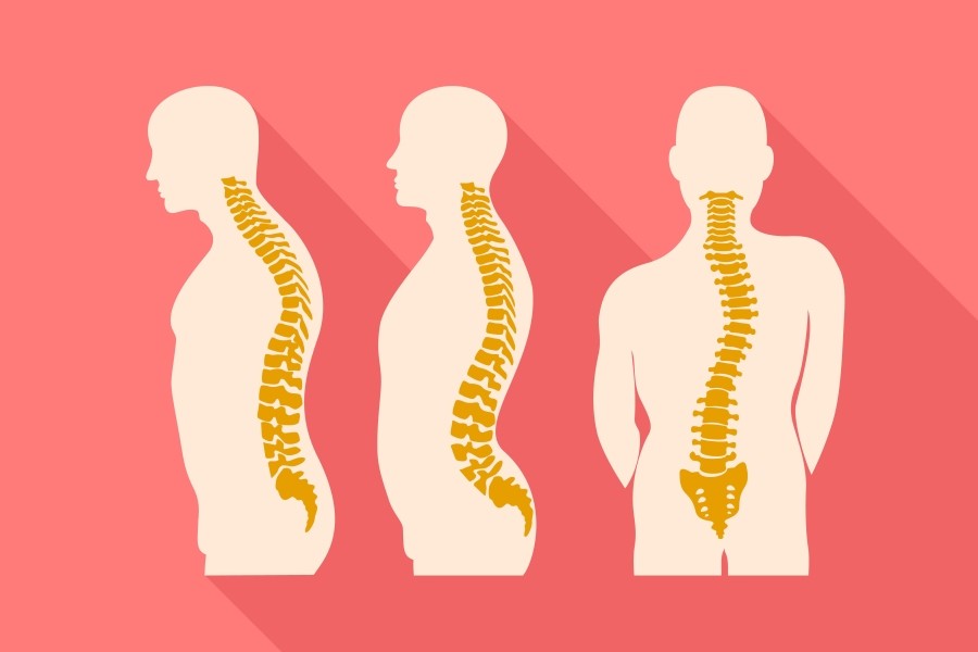 Hiperlordoza kręgosłupa