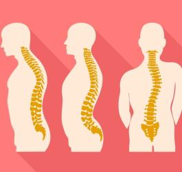 Hiperlordoza kręgosłupa