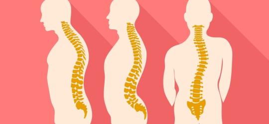 Hiperlordoza kręgosłupa