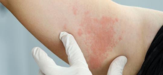 Widoczna na skórze pacjenta wysypka alergiczna, spowodowana działaniem histaminy.