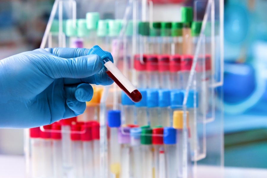 Diagnosta trzyma w dłoni próbkę krwi pacjenta, przeznaczoną do badania poziomu homocysteiny.