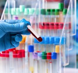 Diagnosta trzyma w dłoni próbkę krwi pacjenta, przeznaczoną do badania poziomu homocysteiny.