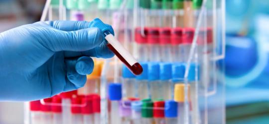 Diagnosta trzyma w dłoni próbkę krwi pacjenta, przeznaczoną do badania poziomu homocysteiny.