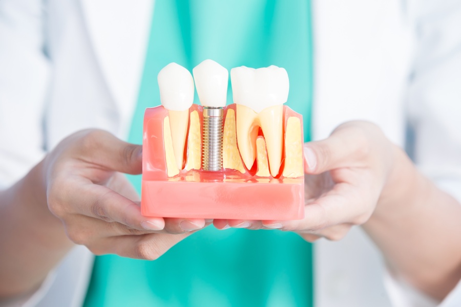 Implant zęba - kied wstawić i ile kosztuje?