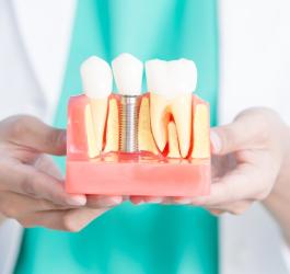 Implant zęba - kied wstawić i ile kosztuje?