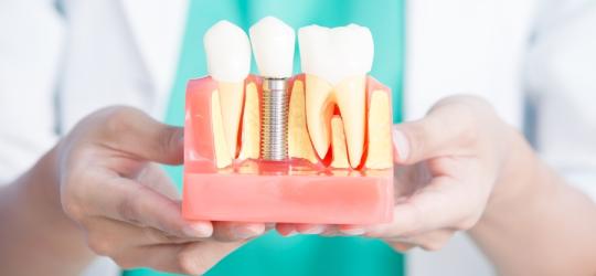 Implant zęba - kied wstawić i ile kosztuje?