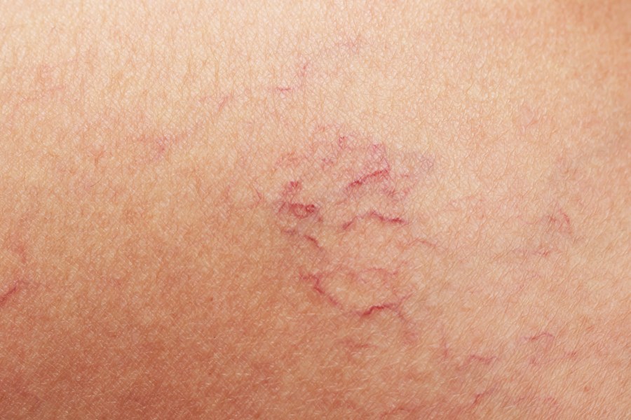 Jak pozbyć się pajączków naczyniowych?