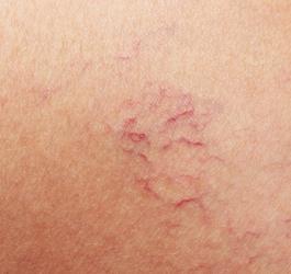 Jak pozbyć się pajączków naczyniowych?