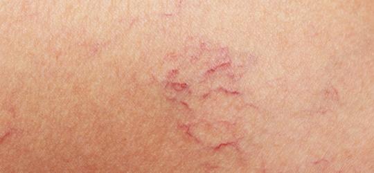 Jak pozbyć się pajączków naczyniowych?