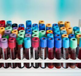 Fiolki zawierające próbki krwi przeznaczone do badania jonogramu.