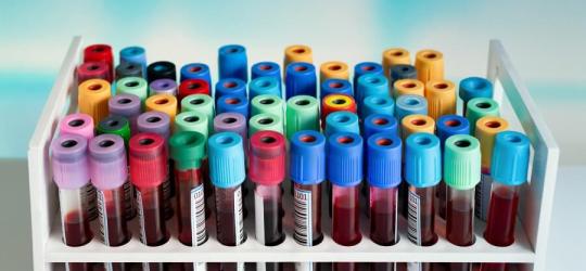 Fiolki zawierające próbki krwi przeznaczone do badania jonogramu.