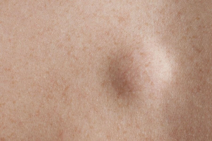 Zbliżenie na ludzką skórę i zmianę na jej powierzchni - kaszaka.