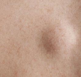 Zbliżenie na ludzką skórę i zmianę na jej powierzchni - kaszaka.