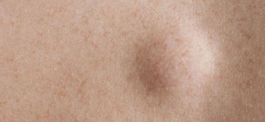 Zbliżenie na ludzką skórę i zmianę na jej powierzchni - kaszaka.