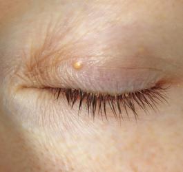 Kępki żółte widoczne na górnej powiece kobiety.