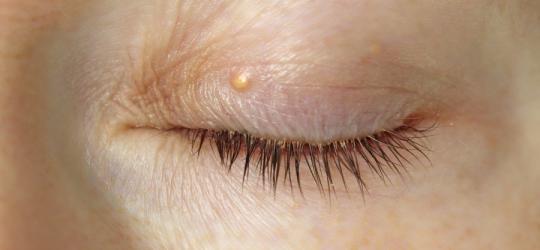 Kępki żółte widoczne na górnej powiece kobiety.