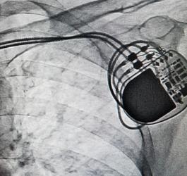 Kiedy potrzebny jest rozrusznik serca?