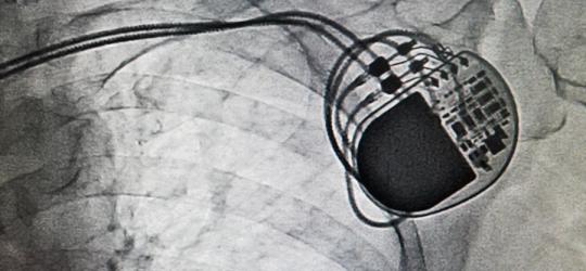 Kiedy potrzebny jest rozrusznik serca?