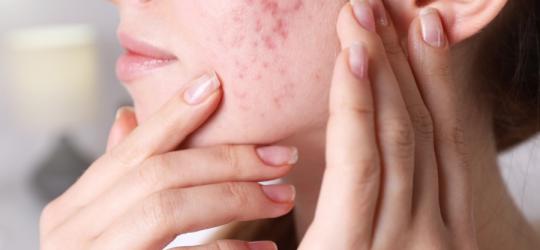 Kobieta dotyka skóry swojej twarzy z widocznymi zmianami trądzikowymi.