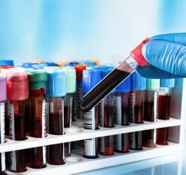 Diagnosta trzyma w dłoni próbkę krwi przeznaczoną do badania.