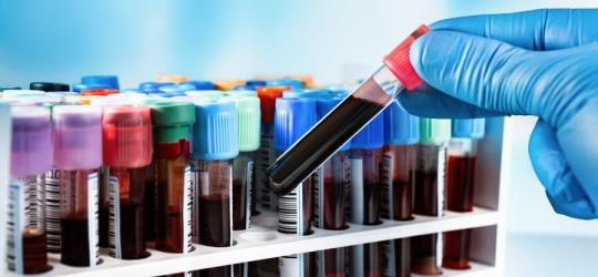 Diagnosta trzyma w dłoni próbkę krwi przeznaczoną do badania.