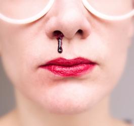 Krew z nosa - co jest przyczyną częstego krwawienia?
