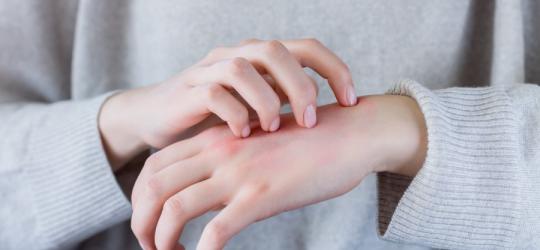 Kobieta ma krosty na rękach, drapie swędząca skórę.